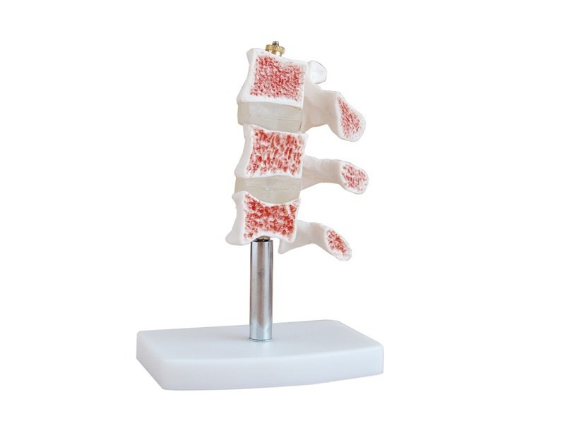 Modelo de Corte de Vertebras Evoluci&oacute;n de Osteoporosis